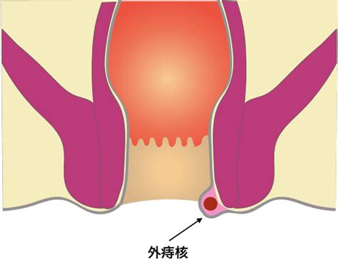 長痔